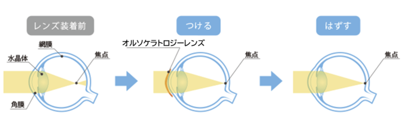 オルソケラトロジーの仕組み