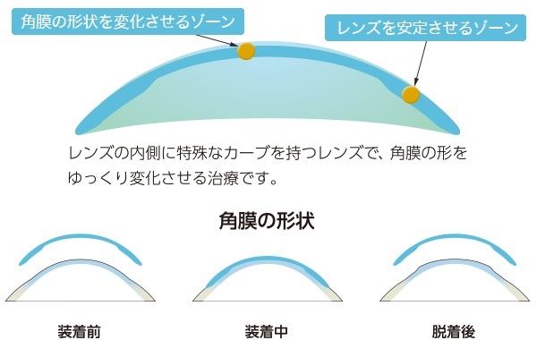 特殊なレンズデザインが角膜の形状を矯正