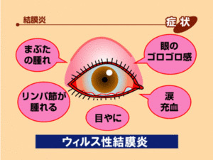 結膜炎とは