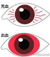 結膜下出血
